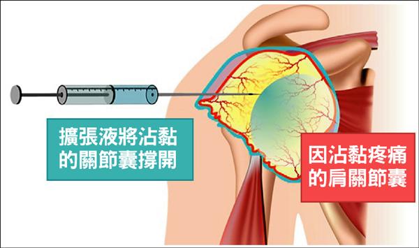 五十肩 